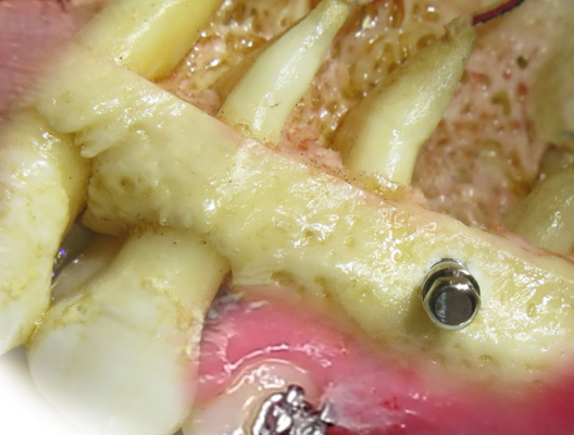 مینی ایمپلنت‌ها چیست و چه کاربردی در درمان ارتودنسی دارد؟